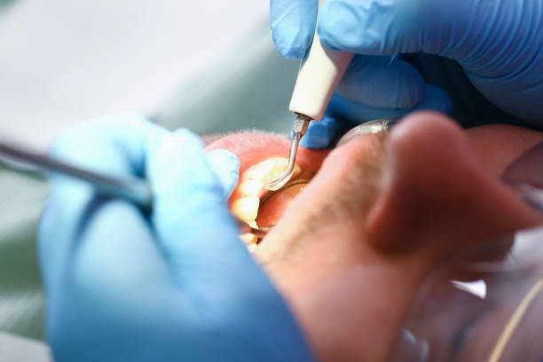Best Emergency Dentist for Knocked-Out Tooth in Gosport, IN
